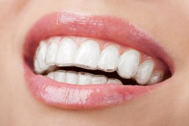 Invisalign-Close how much are braces, how much does braces cost, orthodontic treatment, orthodontic braces, orthodontic services, southern illinois orthodontist, orthodontist carbondale il, orthodontist marion il, orthodontist carterville il, orthodontist Herrin, orthodontist murphysboro, orthodontist giant city, orthodontist johnston city, orthodontist goreville, braces marion il, braces carbondale il, braces cost,