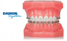 damon-self-ligating-braces how much are braces, how much does braces cost, orthodontic treatment, orthodontic braces, orthodontic services, southern illinois orthodontist, orthodontist carbondale il, orthodontist marion il, orthodontist carterville il, orthodontist Herrin, orthodontist murphysboro, orthodontist giant city, orthodontist johnston city, orthodontist goreville, braces marion il, braces carbondale il, braces cost,