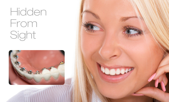 What Are Lingual Braces?