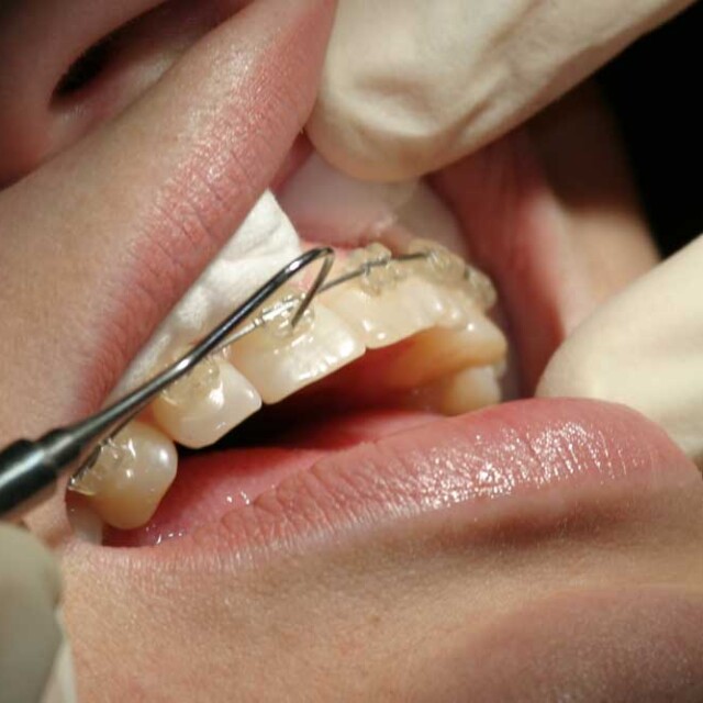 how much are braces, how much does braces cost, orthodontic treatment, orthodontic braces, orthodontic services, southern illinois orthodontist, orthodontist carbondale il, orthodontist marion il, orthodontist carterville il, orthodontist Herrin, orthodontist murphysboro, orthodontist giant city, orthodontist johnston city, orthodontist goreville, braces marion il, braces carbondale il, braces cost,