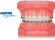 how much are braces, how much does braces cost, orthodontic treatment, orthodontic braces, orthodontic services, southern illinois orthodontist, orthodontist carbondale il, orthodontist marion il, orthodontist carterville il, orthodontist Herrin, orthodontist murphysboro, orthodontist giant city, orthodontist johnston city, orthodontist goreville, braces marion il, braces carbondale il, braces cost,