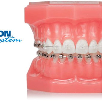 how much are braces, how much does braces cost, orthodontic treatment, orthodontic braces, orthodontic services, southern illinois orthodontist, orthodontist carbondale il, orthodontist marion il, orthodontist carterville il, orthodontist Herrin, orthodontist murphysboro, orthodontist giant city, orthodontist johnston city, orthodontist goreville, braces marion il, braces carbondale il, braces cost,