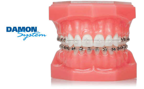 The Damon® System of Braces – Couser Orthodontics