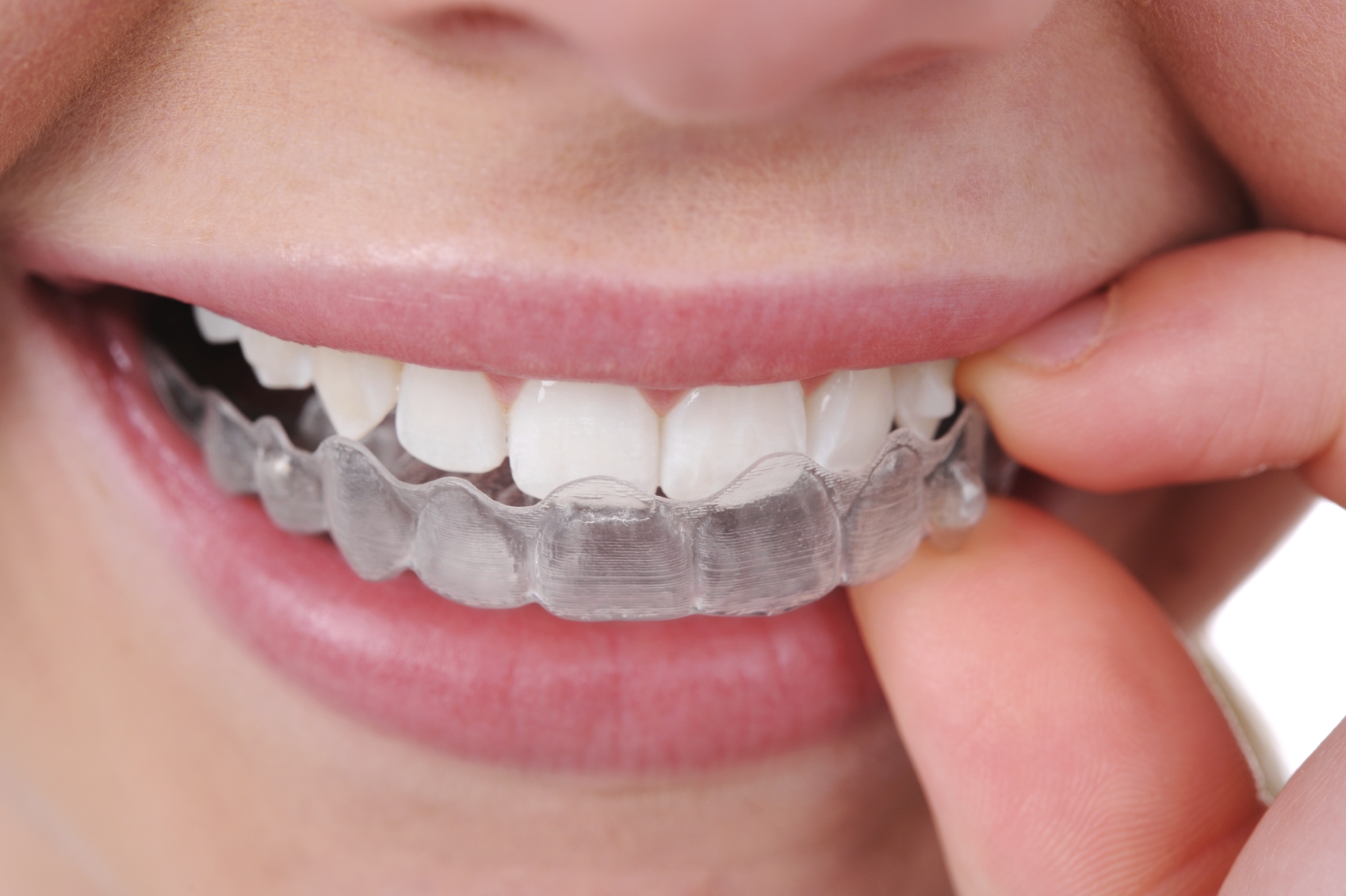 Invisalign® Q&A – Couser Orthodontics